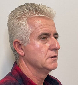 Facelift-Blepharoplasty-Case--291 | Before Facelift for Men 2