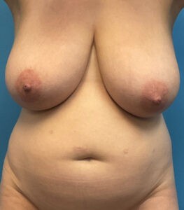 Breast-Reduction-Case--2878 | Before Breast Reduction 1