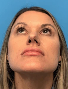 Rhinoplasty-Case--4972 | Before Face 2