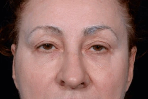 Blepharoplasty-Case--9685 | Before Face 1