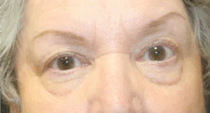 Blepharoplasty-Case--6005 | Before Face 1