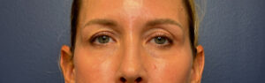 Blepharoplasty-Case--8003 | Before Dr. Arjun Kanuri 1