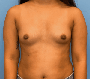 Breast-Augmentation-Case--1115 | Before Dr. Arjun Kanuri 1