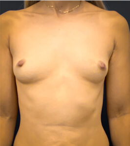Breast-Augmentation-Case--8208 | Before Dr. Arjun Kanuri 1