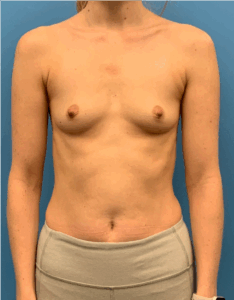 Breast-Augmentation-Case--5309 | Before Breast Augmentation 1