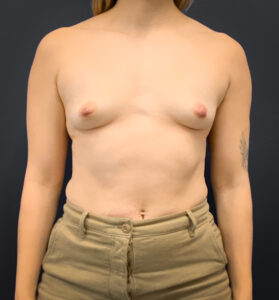 Breast-Augmentation-Case--2225 | Before Breast Augmentation 1
