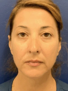 Facelift-Case--8368 | Before Face 1