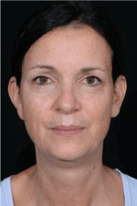 Face-and-Neck-Lift-Case--9403 | Before Face 1