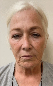 Facelift-Case--8874 | Before Face 1