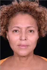 Face-and-Neck-Lift-Case--3772 | Before Face 1