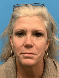 Facelift-Case--8163 | Before Face360 1