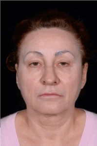 Face-and-Neck-Lift-Case--8423 | Before Face 1
