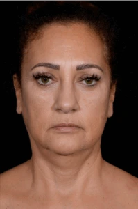 Necklift-Case--4869 | Before Face 1