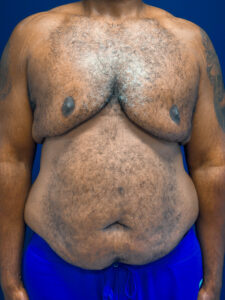 Gynecomastia-Case--4473 | Before Gynecomastia / Male Breast Reduction 1