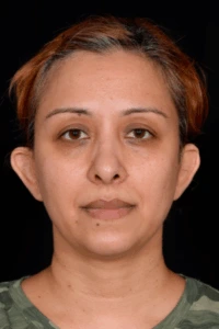 Otoplasty-Case--4655 | Before Face 1