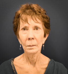 Facial-Fat-Grafting-Case--5079 | Before Facial Fat Grafting 1