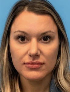 Rhinoplasty-Case--4972 | Before Face 1