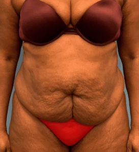 Abdominoplasty-Case--4427 | Before Tummy Tuck 1