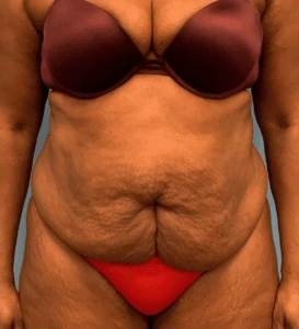 Abdominoplasty-Case--4427 | Before Body 1