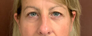 Upper-Blepharoplasty-Case--7202 | Before Eyelid Surgery 1