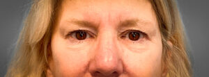 Blepharoplasty-Case--2653 | Before Eyelid Surgery 1