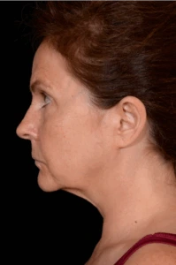 Necklift-Case--4836 | Before Face 2