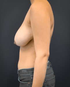 Breast-Reduction-Case--2399 | Before Breast Reduction 2