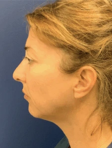 Facelift-Case--8368 | Before Face 2