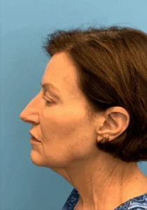 Facelift-Case--6591 | Before Face 2