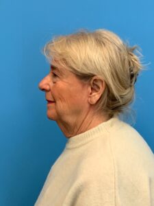 Facelift-Case--6034 | Before Facelift 2