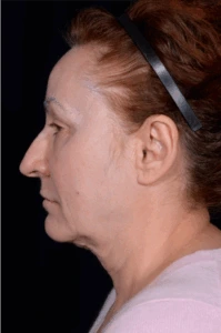 Face-and-Neck-Lift-Case--8423 | Before Dr. Arjun Kanuri 2