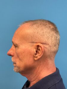 Rhinoplasty-Case--3129 | Before Rhinoplasty for Men 2