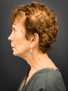 Facial-Fat-Grafting-Case--5079 | Before Facial Fat Grafting 2