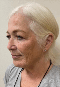 Necklift-Case--7769 | Before Neck Lift 2