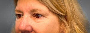 Blepharoplasty-Case--2653 | Before Eyelid Surgery 2