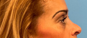 Quad-Blepharoplasty-Case--1261 | Before Eyelid Surgery 2