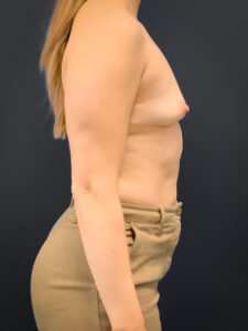 Breast-Augmentation-Case--2225 | Before Breast Augmentation 2