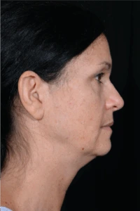 Face-and-Neck-Lift-Case--9403 | Before Face 2
