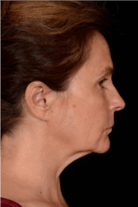 Facelift-Case--4160 | Before Face 2