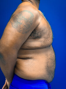 Gynecomastia-Case--4473 | Before Gynecomastia / Male Breast Reduction 2