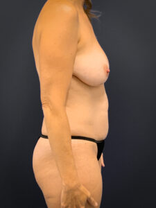Breast-Augmentation-Case--1469 | Before Breast Augmentation 2