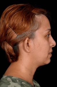 Otoplasty-Case--4655 | Before Face 2