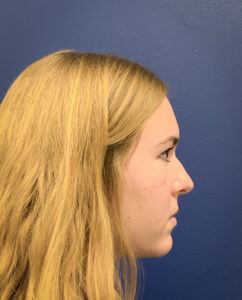 Rhinoplasty-Case--6484 | Before Dr. Arjun Kanuri 2