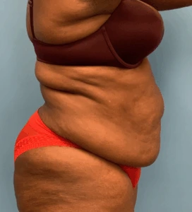 Abdominoplasty-Case--4427 | Before Body 2