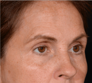 Quad-Blepheroplasty-Case--5361 | Before Eyelid Surgery 2