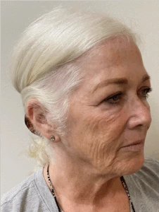 Facelift-Case--8874 | Before Face 2