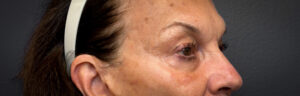 Upper-Blepharoplasty-Case--2075 | Before Eyelid Surgery 2