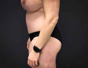 Abdominoplasty-Liposuction-Flanks-Case--6546 | After Liposuction 2