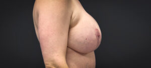 Augmentation-Mastopexy-Case--2453 | After Dr. Samir Rao 2