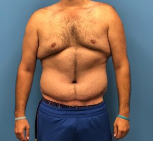 Front view of patient after undergoing a body lift procedure